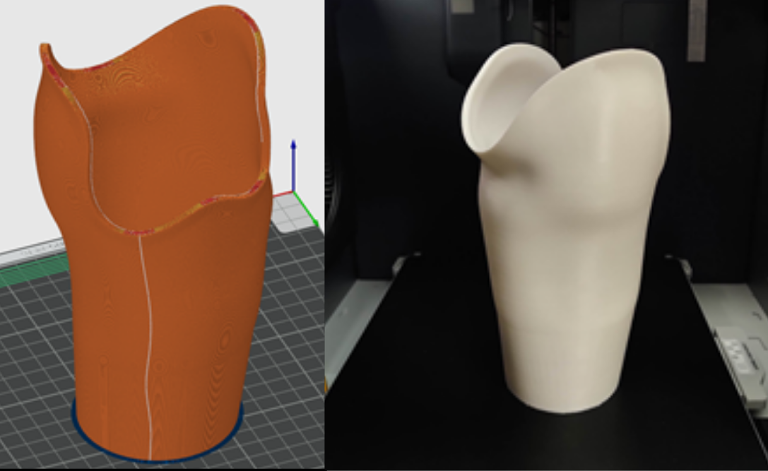VSP for Intra orbital FGR