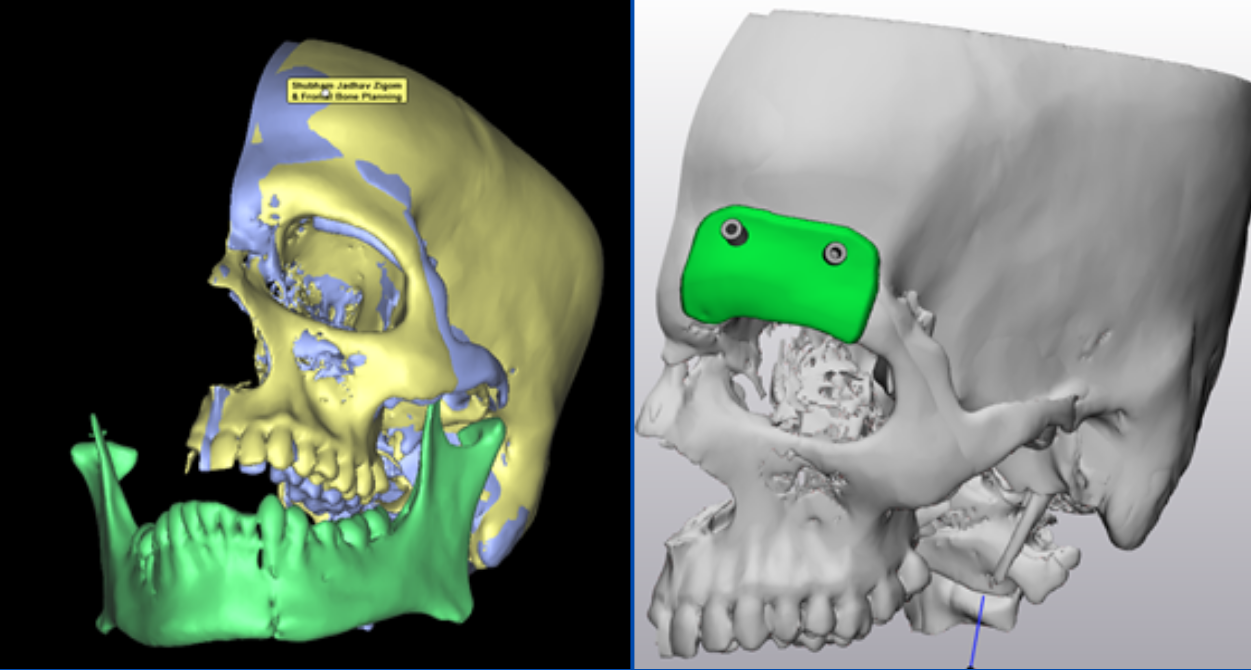 Frontal bone Reconstruction
