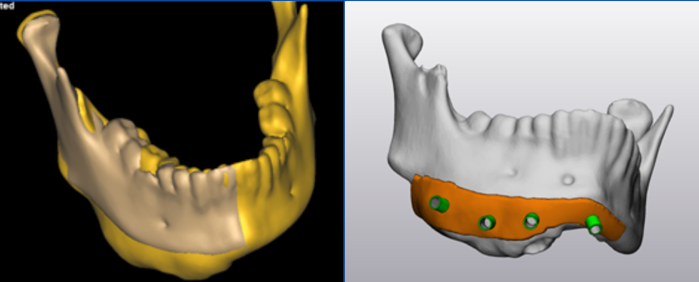 Mandible growth reduction